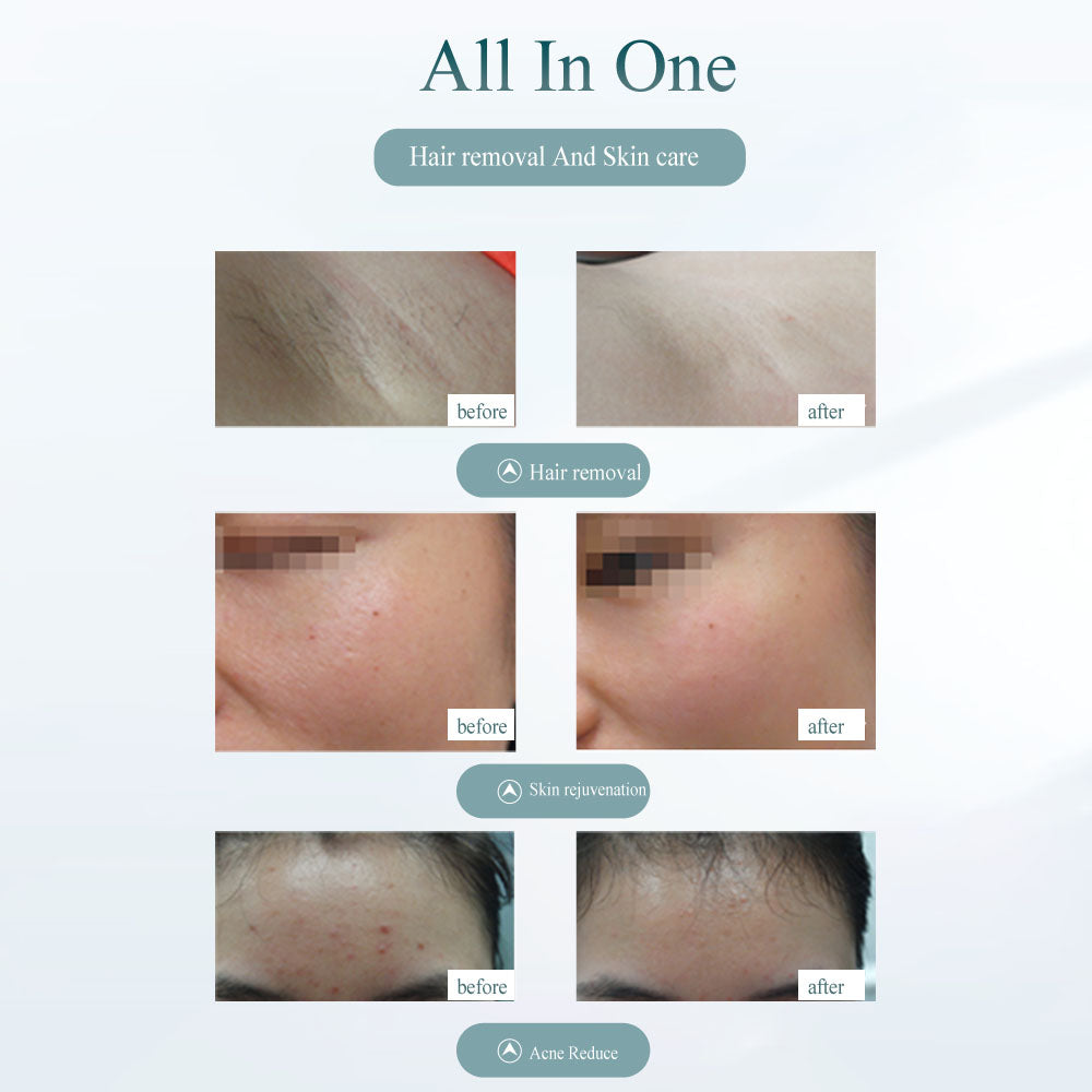 lovenest Laser Hair Removal Device - Painless Hair Removal Tool
